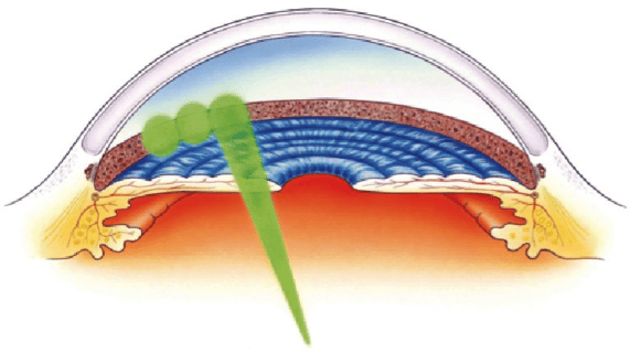 Laser glaucoma treatment graphic