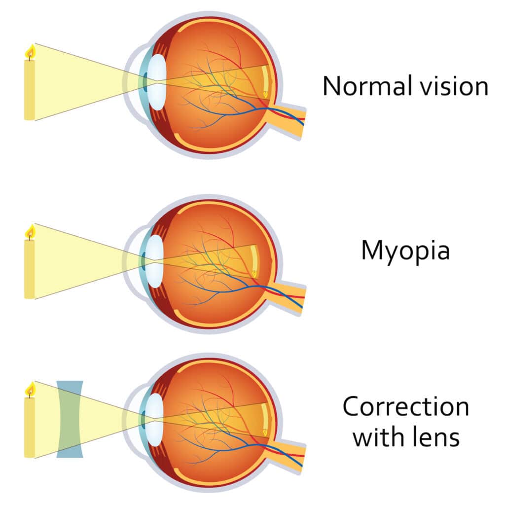 Myopia and myopia corrected by a minus lens. Eye vision disorder.